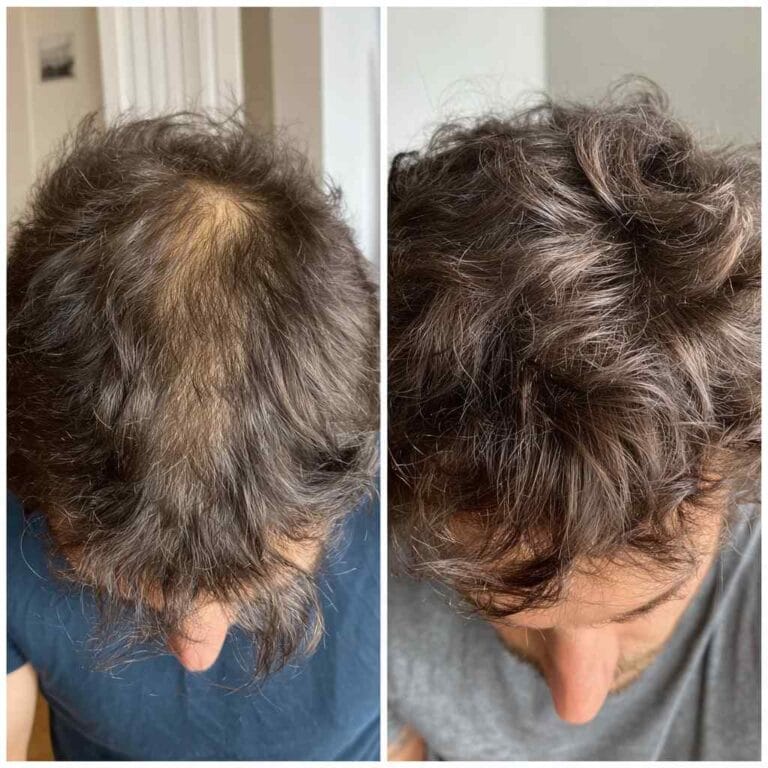 Best Products to Stop Hair Thinning