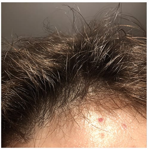 Products for Scalp Acne & Redness