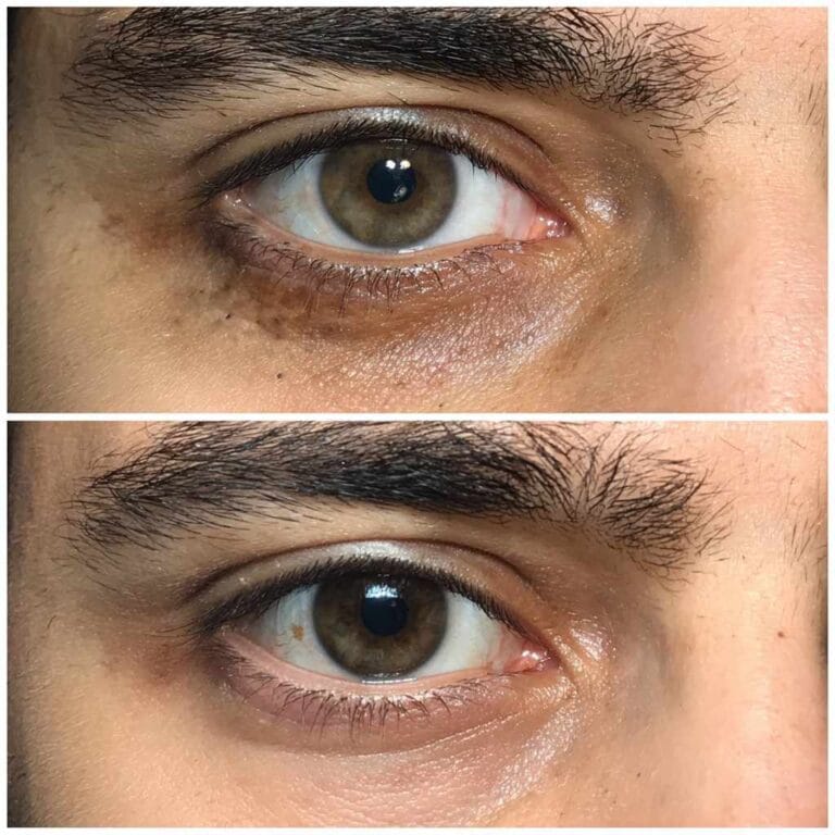 11 Best Eye Creams for Dark Circles